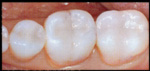 CEREC after | Kozlow & Rowell Dentistry | North Dallas | Addison