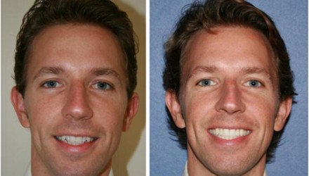 Invisalign, Veneers, and Whitening Before and After Photos | Kozlow & Rowell Dentistry | North Dallas | Addison