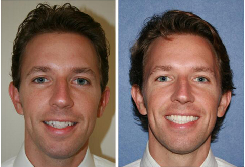 Chris C Before and After | Kozlow & Rowell Dentistry | North Dallas | Addison