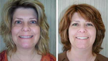 Veneers Before and After Photos | Kozlow & Rowell Dentistry | North Dallas | Addison