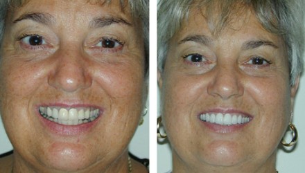 Full Mouth Bridges & Crowns Before and After Photos | Kozlow & Rowell Dentistry | North Dallas | Addison