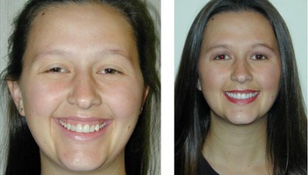 Dental Patient Before and After Photos | Kozlow & Rowell Dentistry | North Dallas | Addison