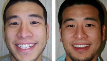 Invisalign Before and After Photos | Kozlow & Rowell Dentistry | North Dallas | Addison