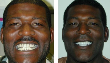 Veneers Before and After Photos | Kozlow & Rowell Dentistry | North Dallas | Addison