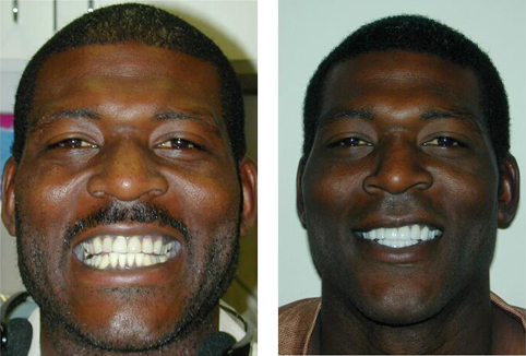 Larry J Before and After | Kozlow & Rowell Dentistry | North Dallas | Addison