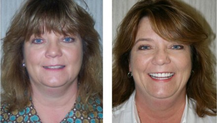 Dental Patient Before and After Photos | Kozlow & Rowell Dentistry | North Dallas | Addison