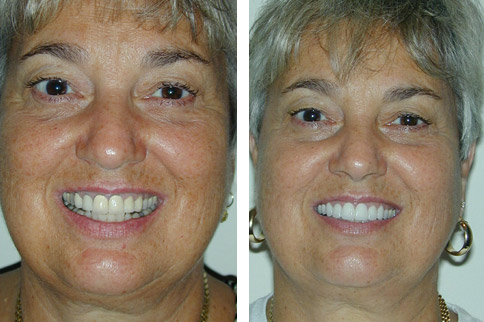 Crowns Before and After Photos | Kozlow & Rowell Dentistry | North Dallas | Addison