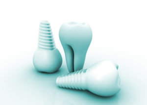 dental implants North Dallas
