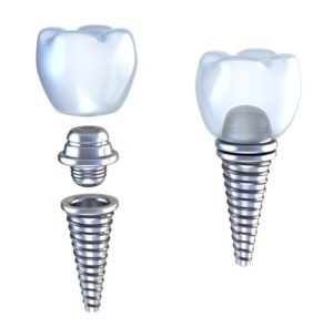 dental implants North Dallas