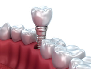 dental implants north Dallas