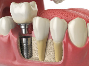 dental implants north Dallas