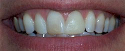 Veneers Patient 2 Before | Kozlow & Rowell Dentistry | North Dallas | Addison