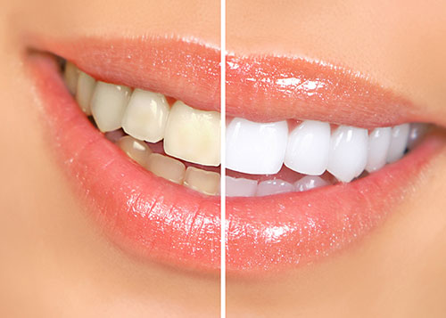 ZOOM! Teeth Whitening | Kozlow & Rowell Dentistry | North Dallas | Addison