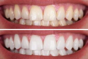 Dallas, TX, dentist offers professional whitening 